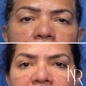 Eyelid surgery before and after photo, close-up view