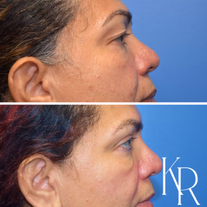 Eyelid surgery before and after photo, side view