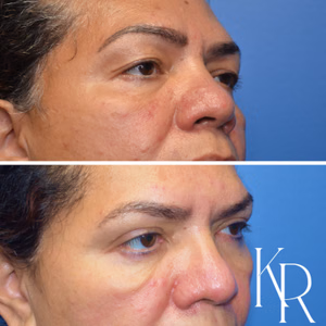 Eyelid surgery before and after photo, front view