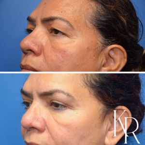 Eyelid surgery before and after photo, side view