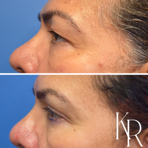 Eyelid surgery before and after photo, side view
