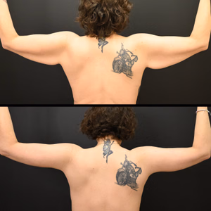 Arm lift before and after photo, rear view