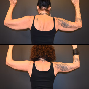 Arm lift before and after photo, rear view