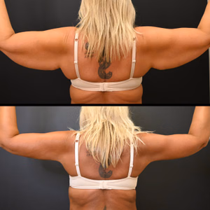 Arm lift before and after photo, rear view