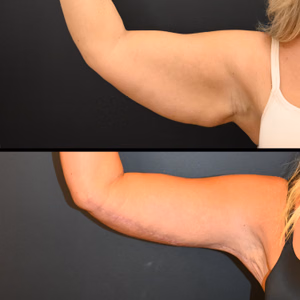 Arm lift before and after photo, side view