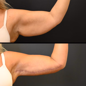 Arm lift before and after photo, side view
