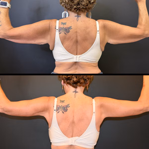 Arm lift before and after photo, rear view