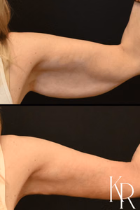 Arm lift before and after photo, side view