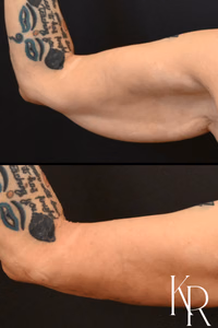 Arm lift before and after photo, side view