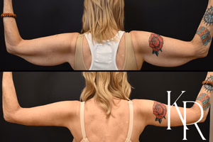 Arm lift before and after photo, rear view