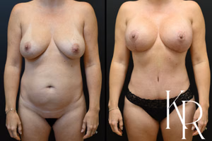 Breast lift with implants before and after photo, front view