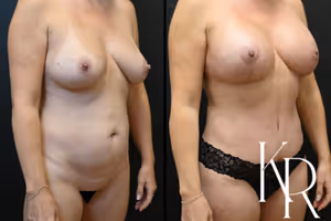Breast lift with implants before and after photo, front view