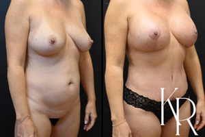 Breast lift with implants before and after photo, front view