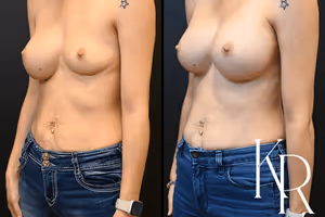 Breast augmentation revision before and after photo, front view