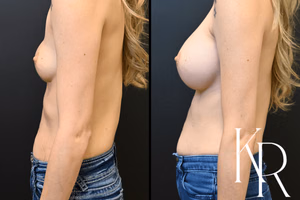 Breast augmentation revision before and after photo, side view