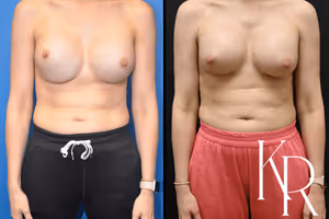 Breast augmentation revision before and after photo, front view