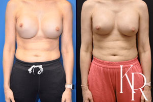 Breast augmentation revision before and after photo, front view