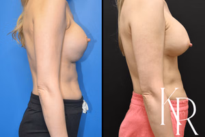 Breast augmentation revision before and after photo, side view