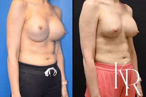 Breast augmentation revision before and after photo, front view