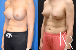 Breast augmentation revision before and after photo, front view
