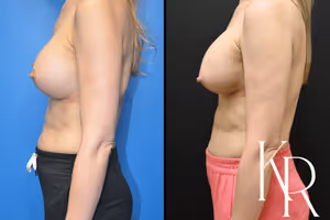 Breast augmentation revision before and after photo, side view