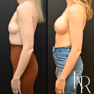 Breast augmentation before and after photo, side view