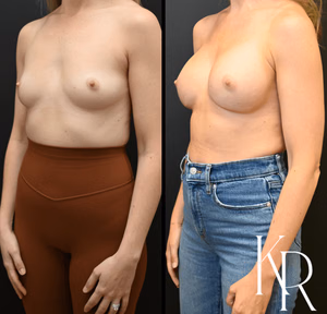 Breast augmentation before and after photo, side view