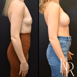 Breast augmentation before and after photo, front view