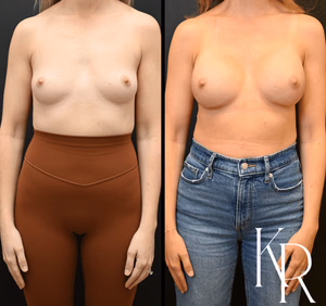 Breast augmentation before and after photo, side view