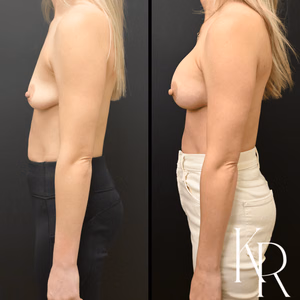 Breast augmentation before and after photo, side view