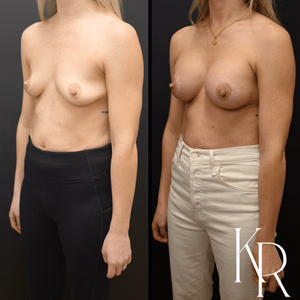 Breast augmentation before and after photo, front view