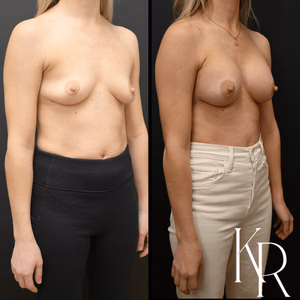 Breast augmentation before and after photo, front view