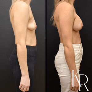 Breast augmentation before and after photo, side view