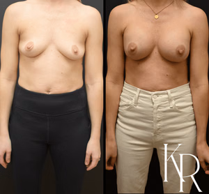 Breast augmentation before and after photo, front view