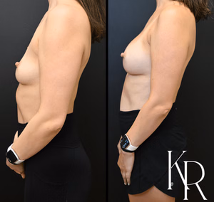 Breast augmentation before and after photo, side view