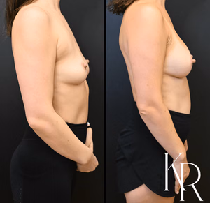 Breast augmentation before and after photo, side view