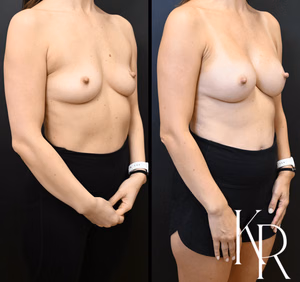 Breast augmentation before and after photo, front view
