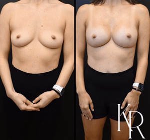 Breast augmentation before and after photo, front view