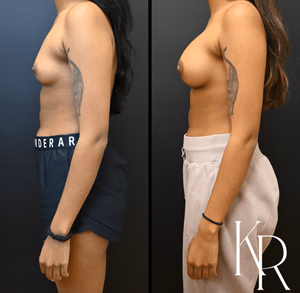 Breast augmentation before and after photo, front view