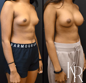 Breast augmentation before and after photo, front view