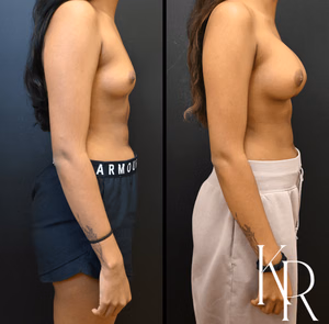 Breast augmentation before and after photo, side view