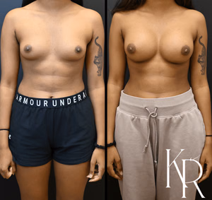 Breast augmentation before and after photo, front view