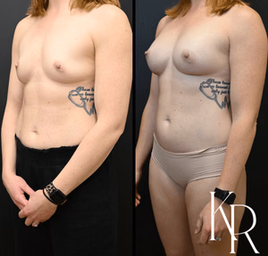 Breast augmentation before and after photo, oblique view