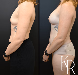 Breast augmentation before and after photo, front view