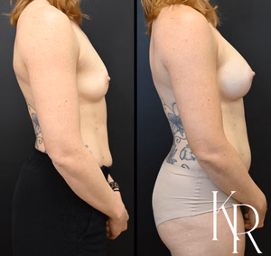 Breast augmentation before and after photo, side view