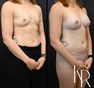Breast augmentation before and after photo, front view