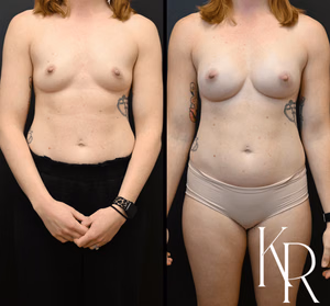 Breast augmentation before and after photo, front view