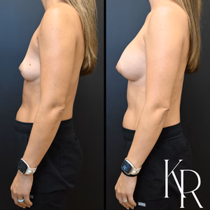 Breast augmentation before and after photo, side view