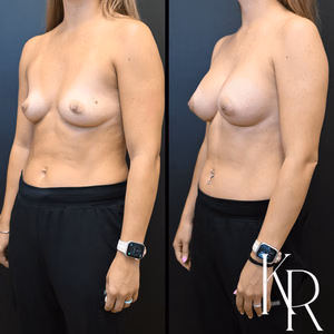 Breast augmentation before and after photo, front view