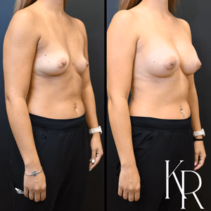 Breast augmentation before and after photo, front view